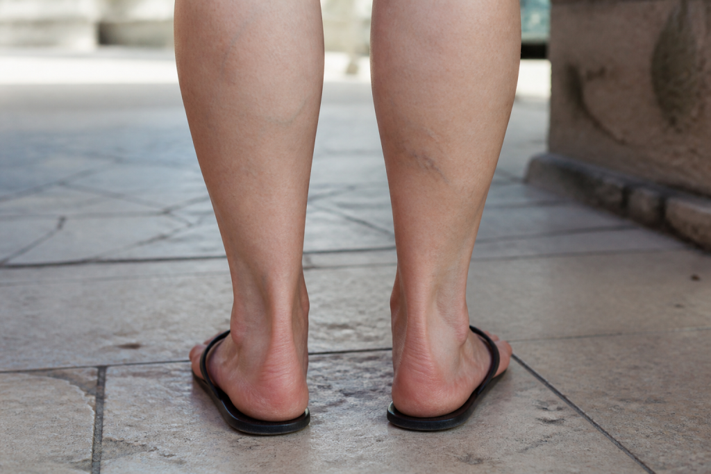 Mollets feminins avec veines bleutees visibles au repos